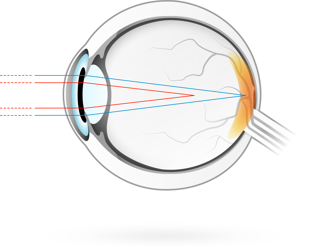 Astigmatismo – afección en la que la curvatura de la córnea es asimétrica, con lo cual los rayos de luz se enfocan en dos puntos en lugar de uno, provocando una visión borrosa