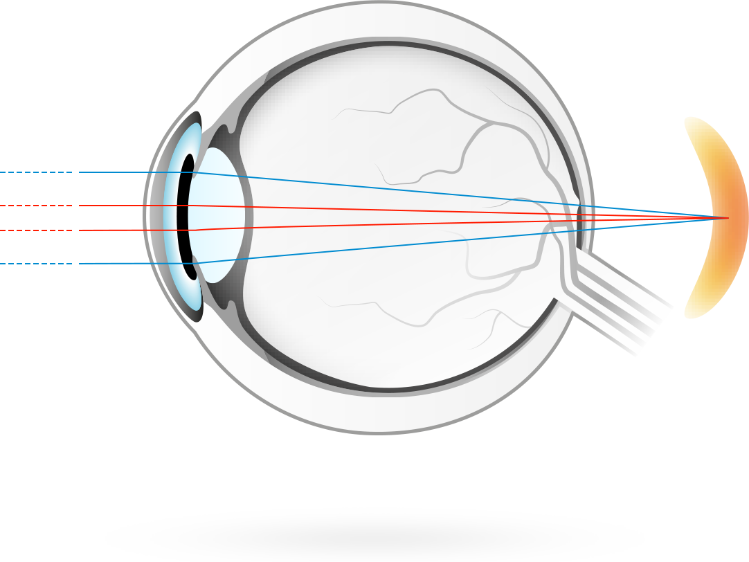 Hipermetropía – afección en la que las imágenes visuales se enfocan por detrás de la retina, haciendo que a los ojos les cueste más enfocar objetos cercanos