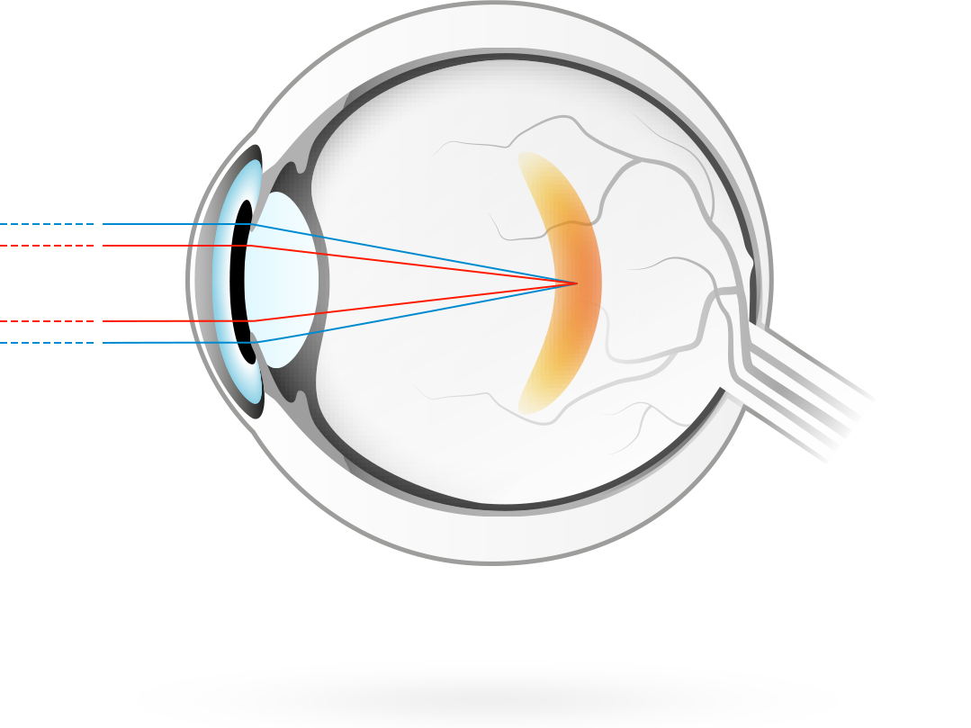 Miopía – afección en la que las imágenes visuales se enfocan delante de la retina, haciendo que la visión de lejos resulte borrosa