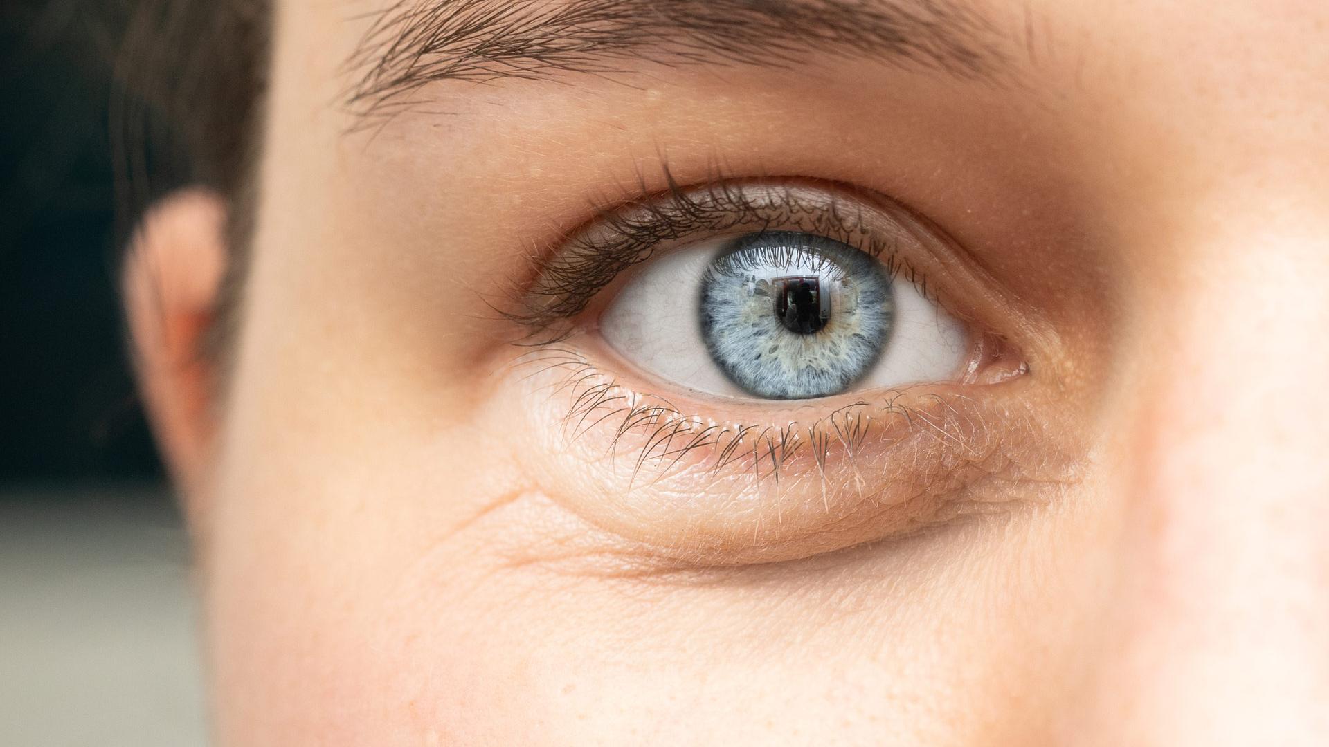 Ojos hinchados, ojeras, enrojecimiento y ardor de ojos