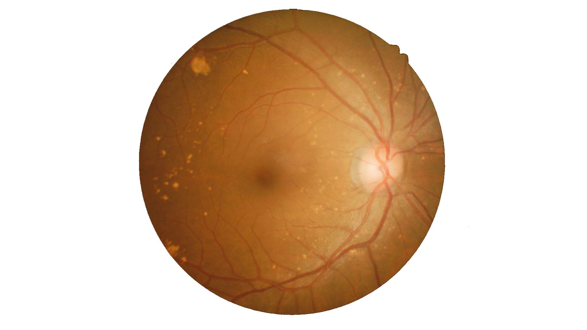 Lesiones retinales