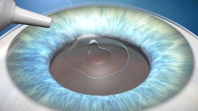 Anestesia ocular