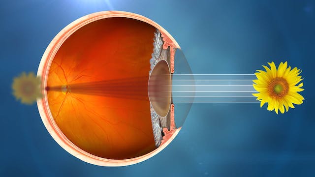 Visualización ilustrativa de un ojo afectado por cataratas.