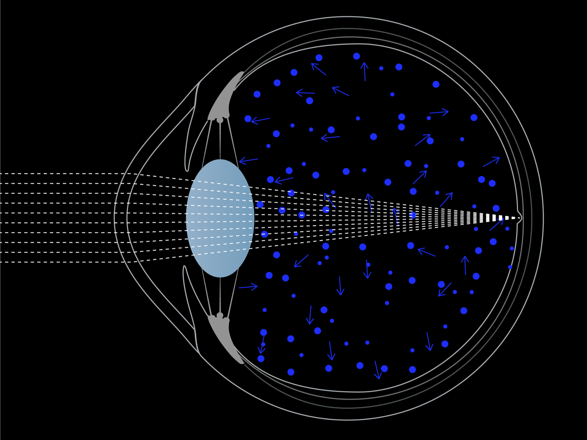 Ilustración de la luz que entra en el ojo, que muestra cómo la luz azul se dispersa más por el ojo que la luz blanca. 