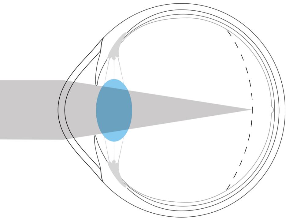 Ilustración de un ojo miope que muestra que la luz se enfoca delante de la retina.