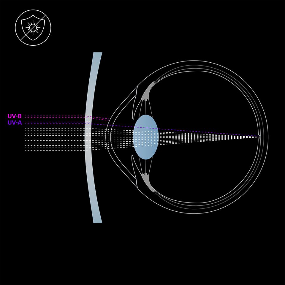 Ilustración del ojo y una lente sin protección UV, que transmite los rayos de luz UVA y UVB al ojo.  