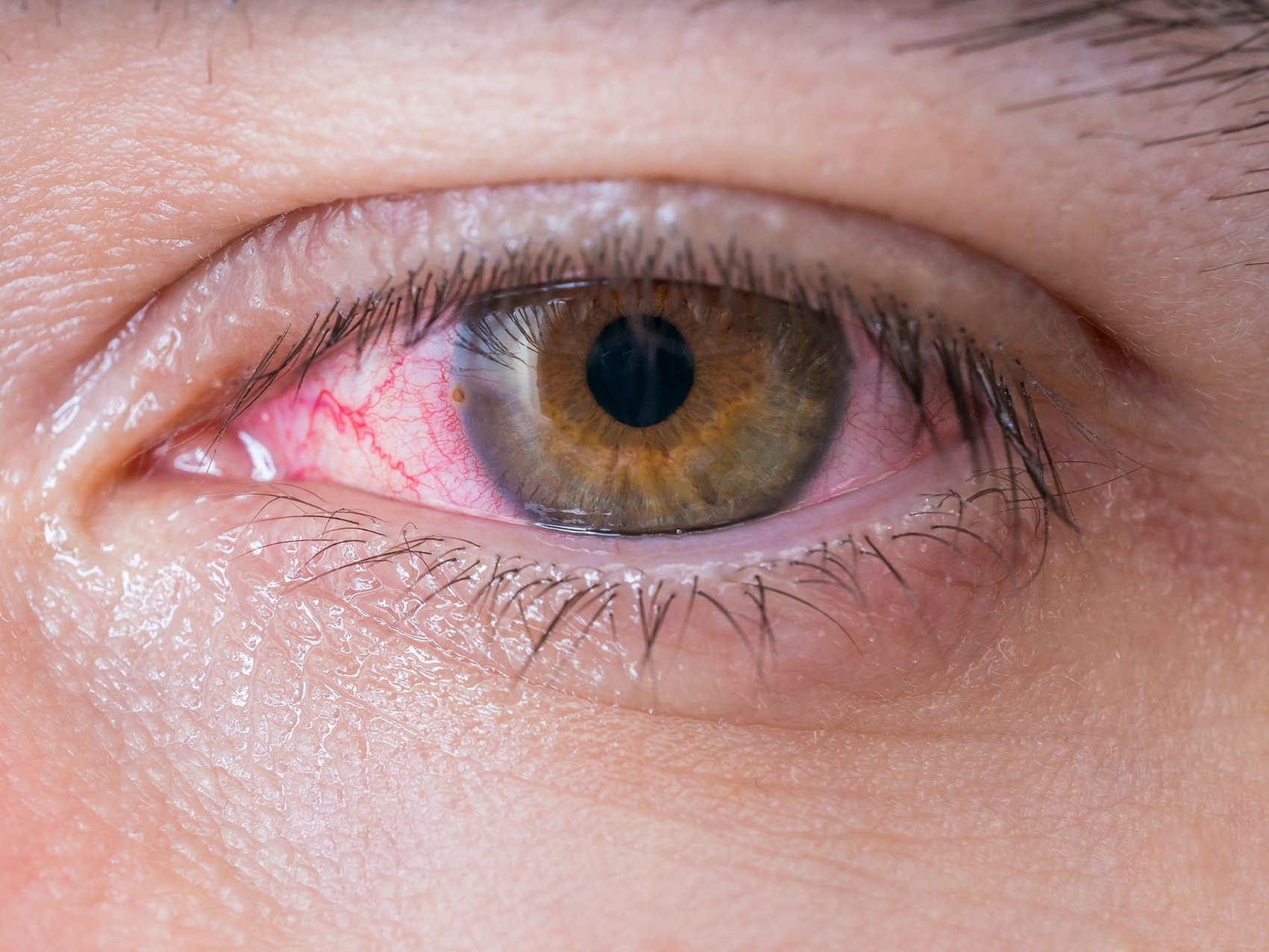 La imagen muestra un primer plano de un ojo con problemas de salud que ejemplifica la aparición de los posibles riesgos oculares. 